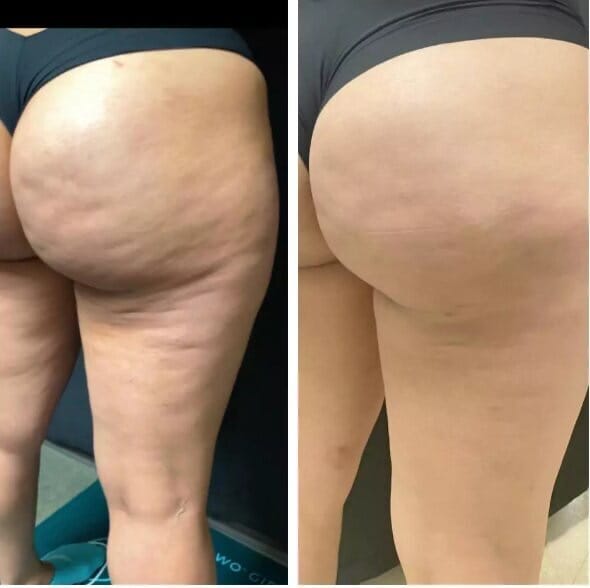 ANTI-CELLULITE MASSAGE OIL™