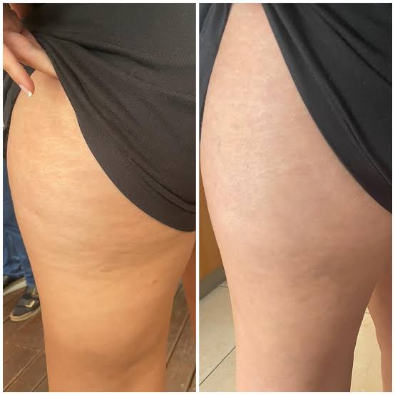 ANTI-CELLULITE MASSAGE OIL™