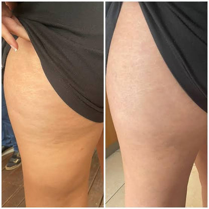 ANTI-CELLULITE MASSAGE OIL™